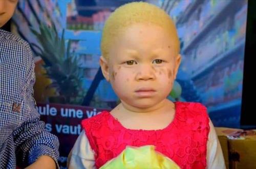 Goma : le trafic d'organes des albinos pour des fins mystiques refait surface