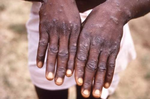Une maladie apparente à la Mpox déclarée dans l'EGEE/Beni