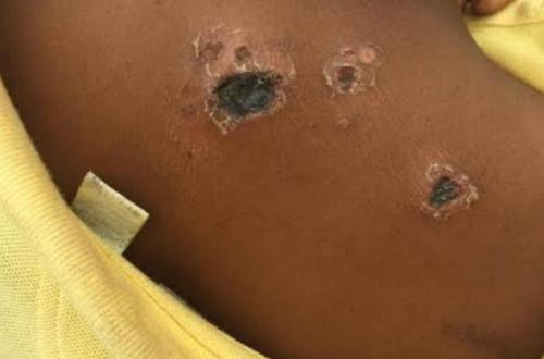 L'épidémie d'anthrax confirmée sur les cadavres de 47 hippopotames dans le territoire de Rutshuru