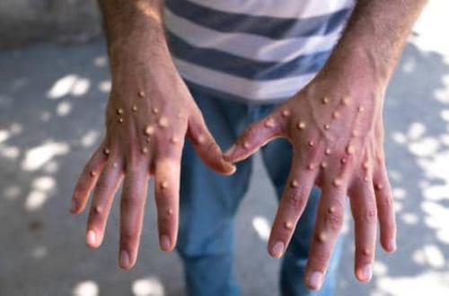Un cas de Mpox confirmé à Lomé : le gouvernement Togolais appelle à la vigilance