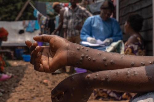 RDC : légère baisse des cas de choléra et suivi du M-pox à la neuvième semaine de 2026