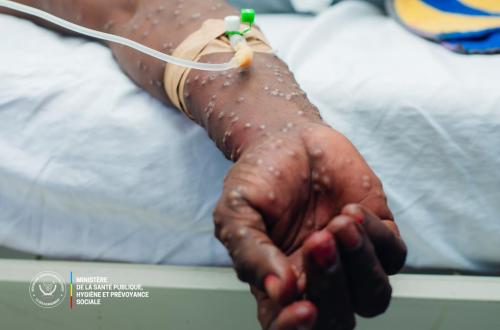 RDC : recul du choléra et légère baisse du M-pox